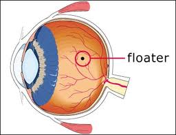 How do you remove eye floaters?