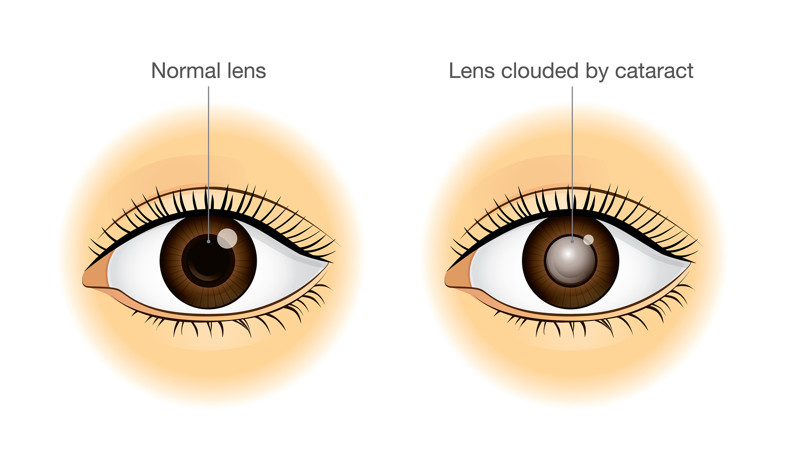 Facts About Cataracts Image