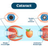 Cataracts and Your Diet Image