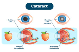 Cataracts and Your Diet Image