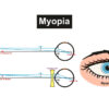 Demonstration on Nearsightedness