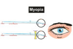 Demonstration on Nearsightedness