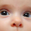 Congenital Cataracts Image