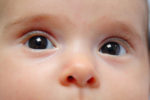 Congenital Cataracts Image