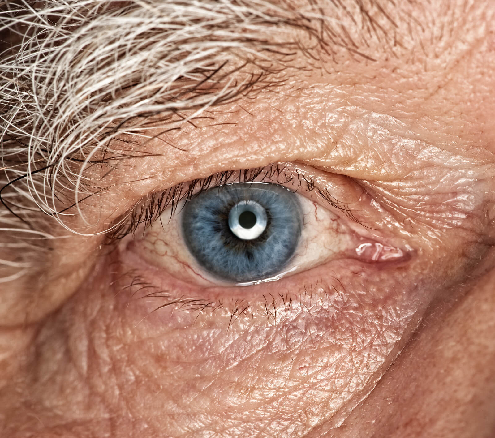 Старые глазки. Старческая(сенильная)катаракта.