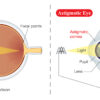 Keeping Astigmatism at Bay Image