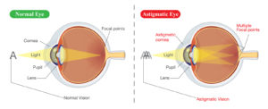 Keeping Astigmatism at Bay Image