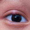 Natural Remedies for Common Eye Problems Image