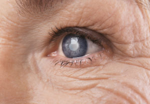 How to Prevent Glaucoma, Cataracts, and Macular Degeneration