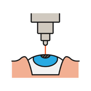 Color drawing of an eyeball undergoing LASIK surgery.