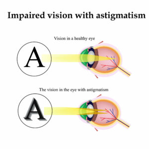 Naturally Improve Poor Vision Caused by Astigmatism