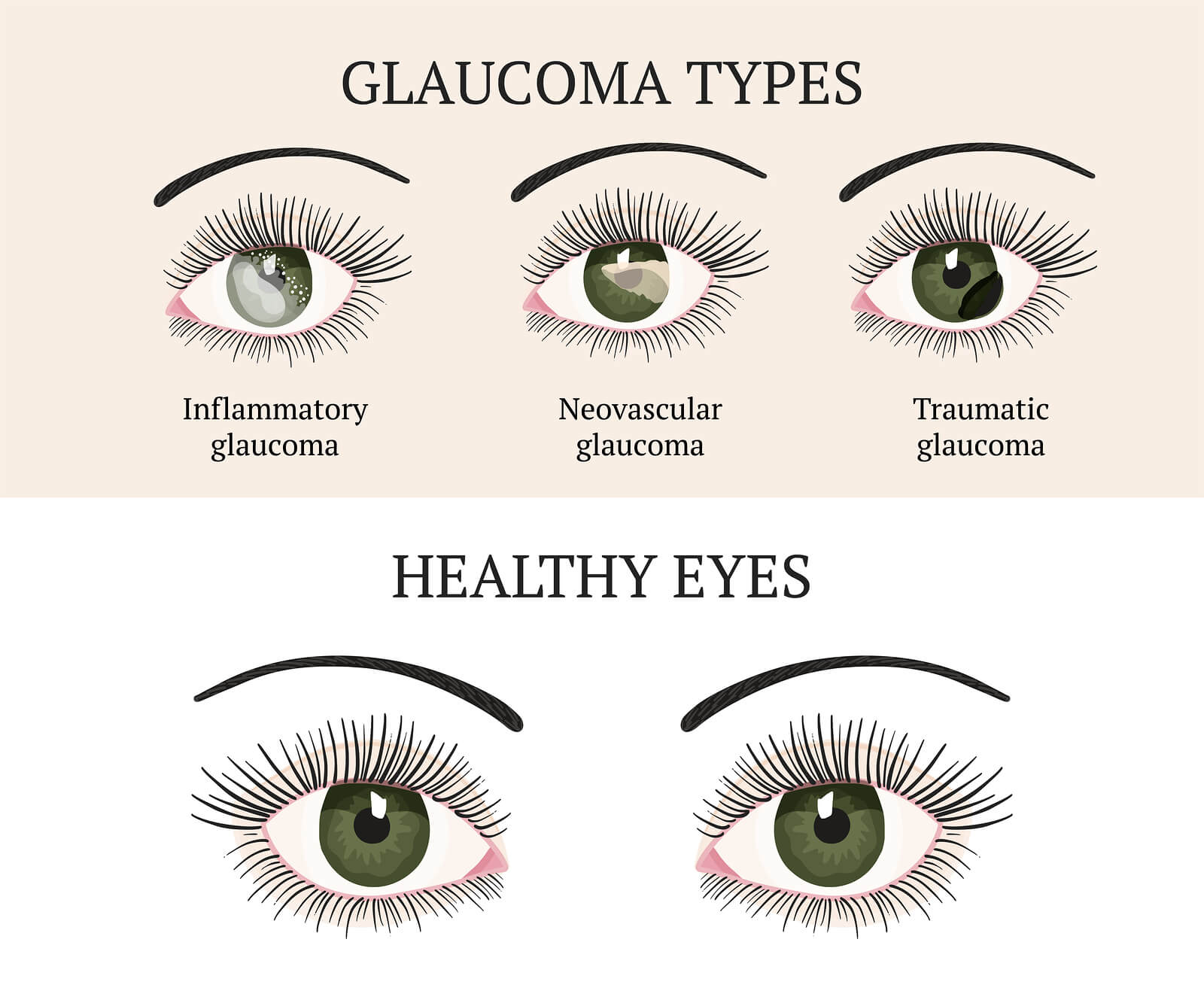 Eye Pressure Chart