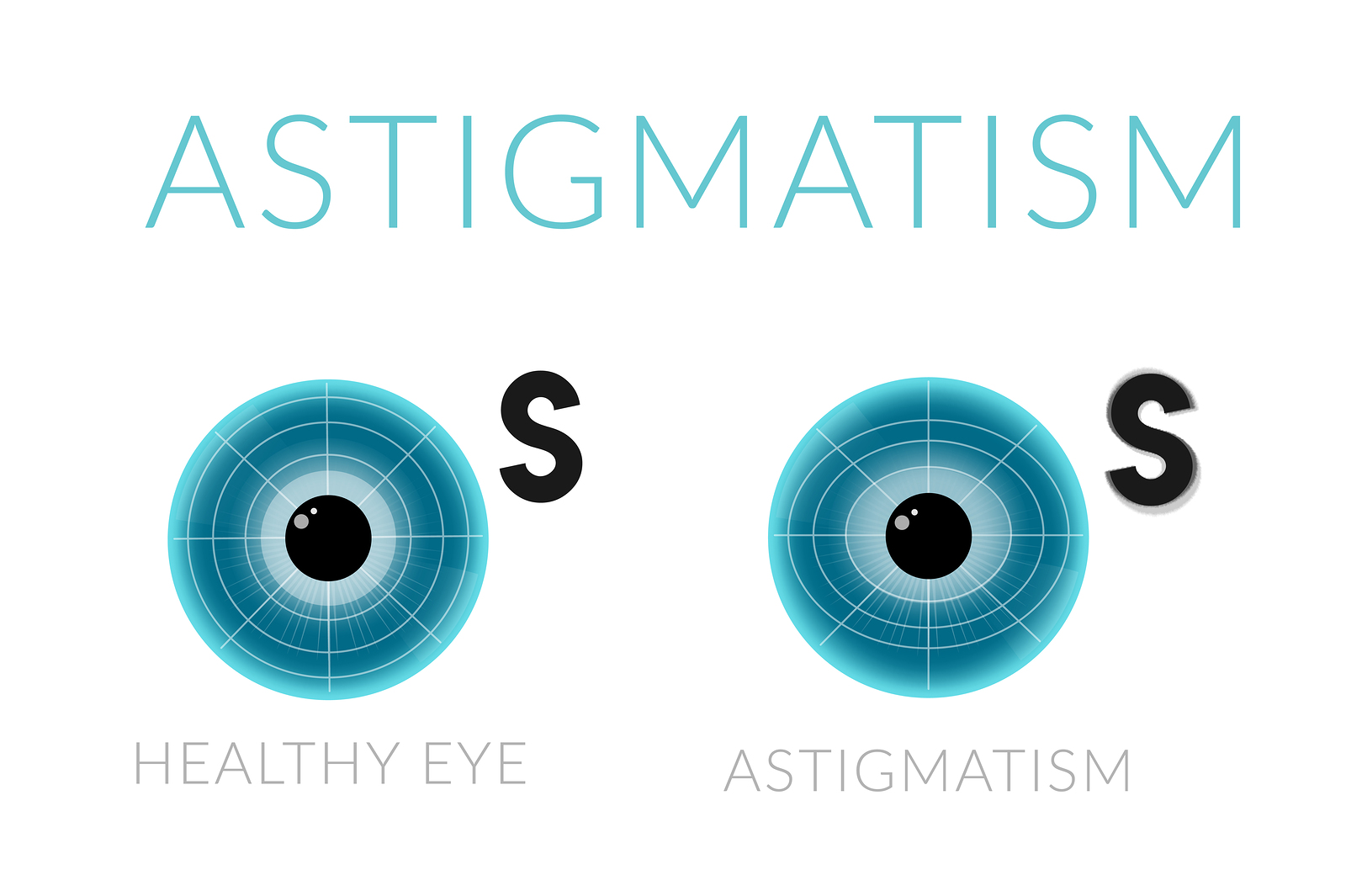 ¿Puede el astigmatismo desaparecer naturalmente?