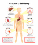 Vitamin Deficiencies and Vision Loss