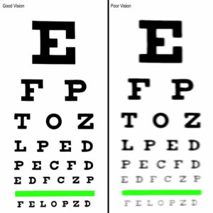 Eye Exercises for People with Different Prescriptions for Each Eye