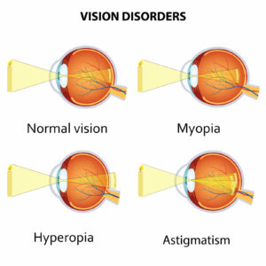 hyperopia myopia astigmatism)