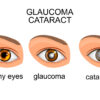 Common Eye Disorder Image