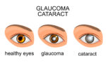 Common Eye Disorder Image