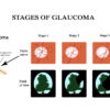 Prevent Glaucoma Image