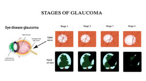 Prevent Glaucoma Image