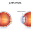 Prevent Cataracts Naturally Image
