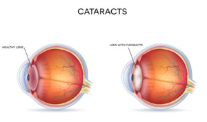 Prevent Cataracts Naturally Image