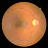 Normal-Tension Glaucoma Image