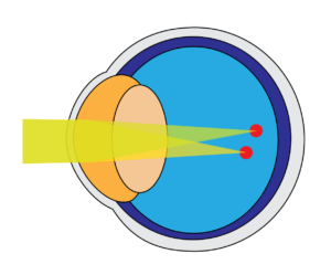 Eye Exercises for Astigmatism