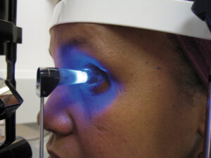 Close-up of a patient having intraocular eye pressure measured using Goldmann applanation tonometry.